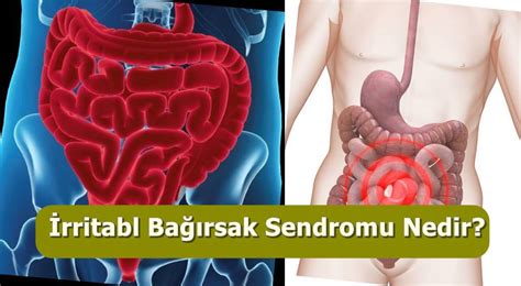 "İrritabl Bağırsak Sendromu (IBS) Belirtileri"